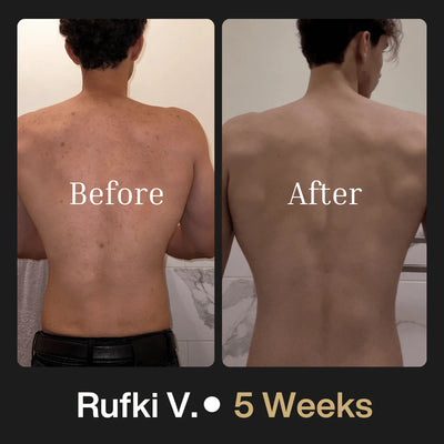 Shield Body Acne Wash