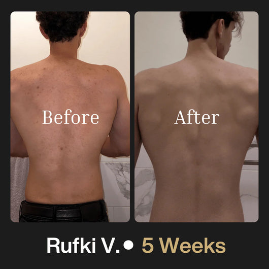 Shield Body Acne Wash